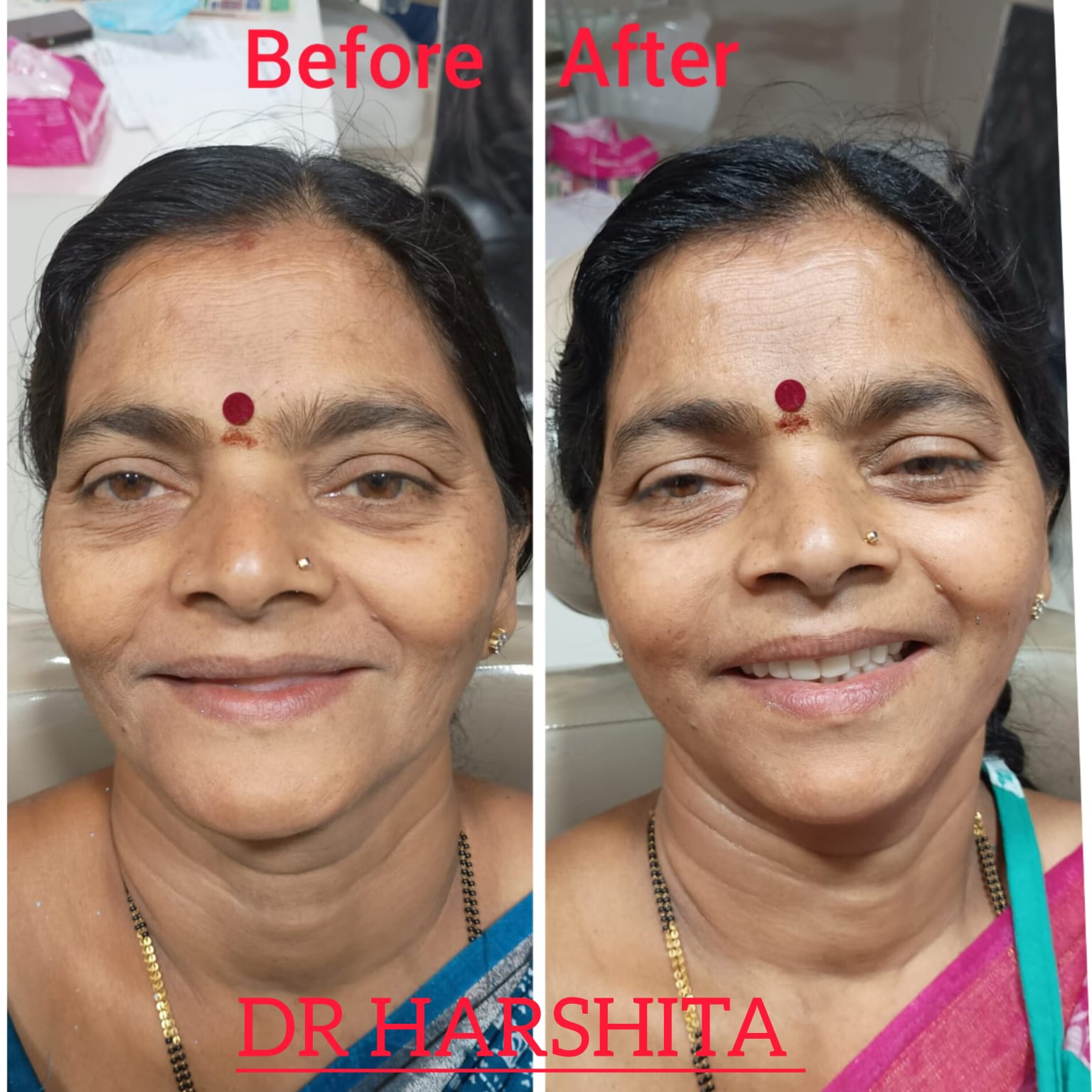 Before & After - Skin Treatment
